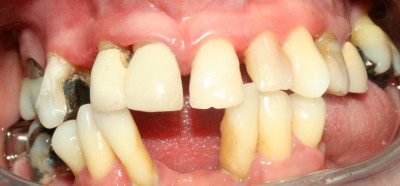 dentadura